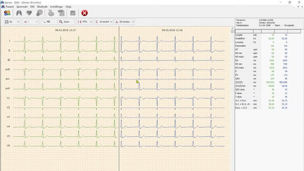 Sammenligne EKG